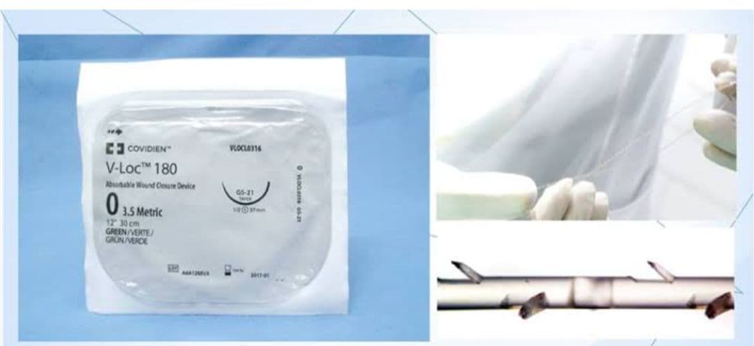 V-Loc 180 吸収性縫合器具 3-0 コビディエン